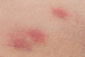 Close up signs of flea bites on skin
